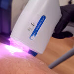 Depilación láser SHR